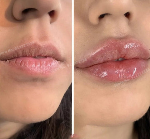 Lippenhyaluronsäure, vernetzte HA-Verbesserung